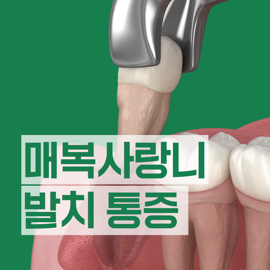 김해 내외동 사랑니 치과 매복사랑니 발치 통증 강도 차이