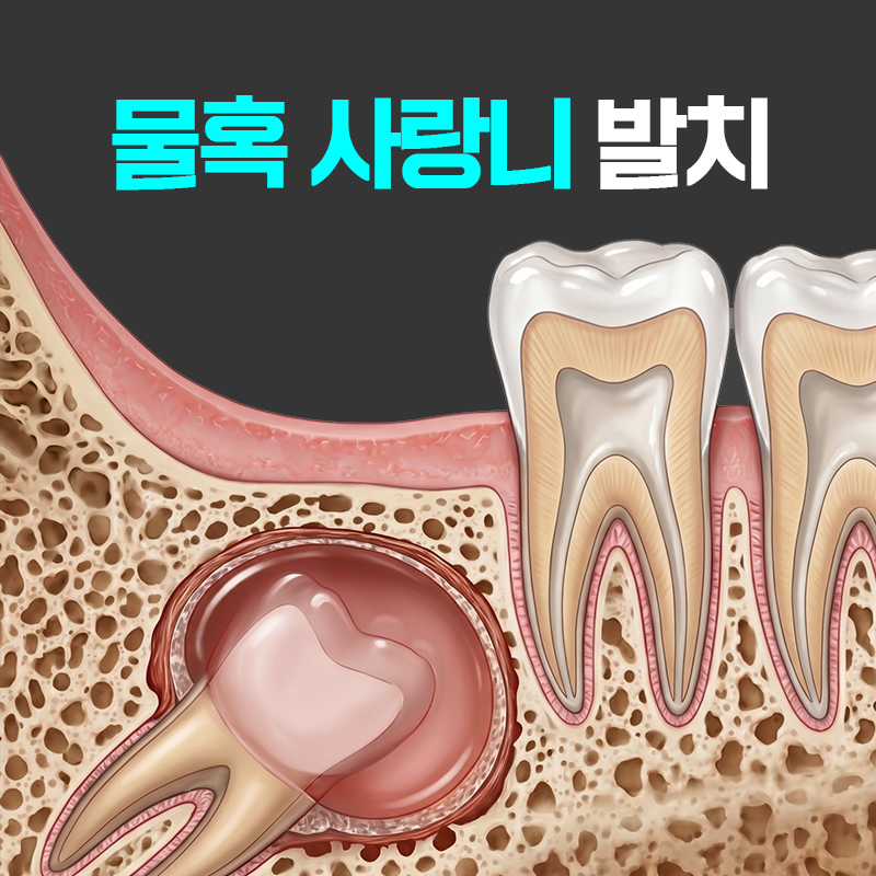 김해 내외동 치과 물혹 사랑니 발치법