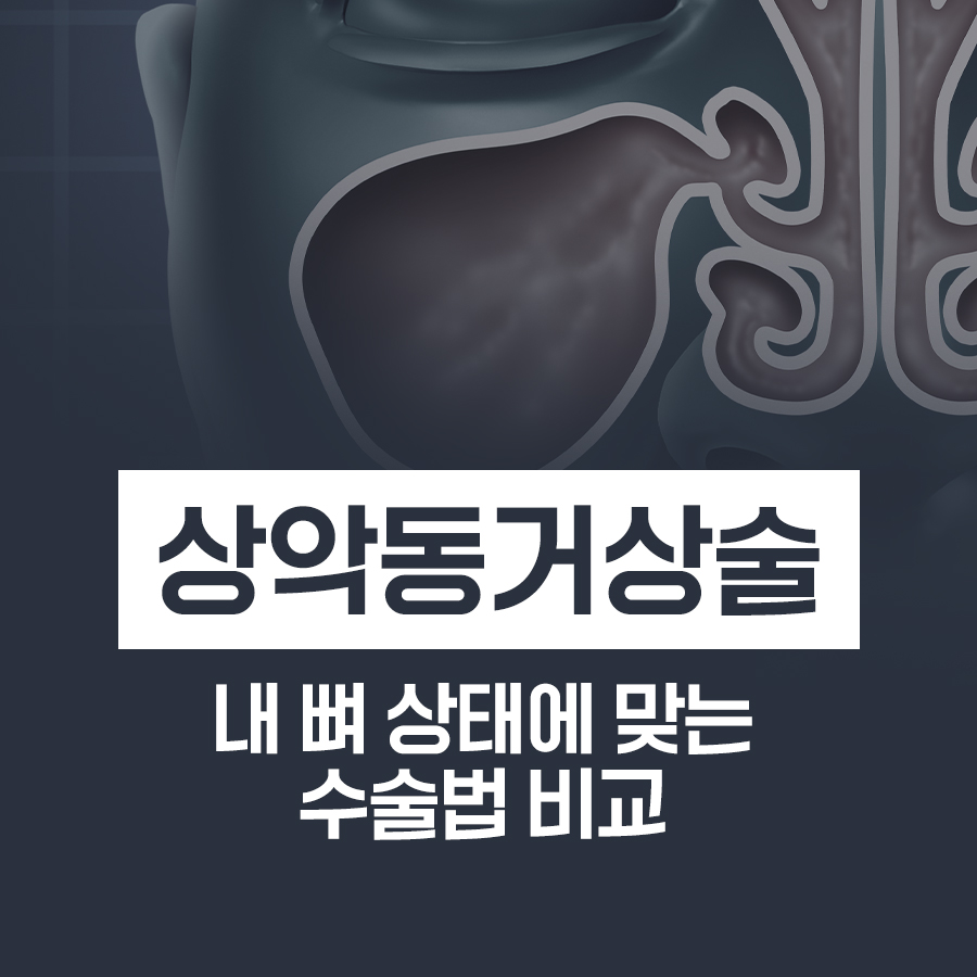 김해임플란트 상악동거상술 내 뼈 상태에 맞는 수술법 비교