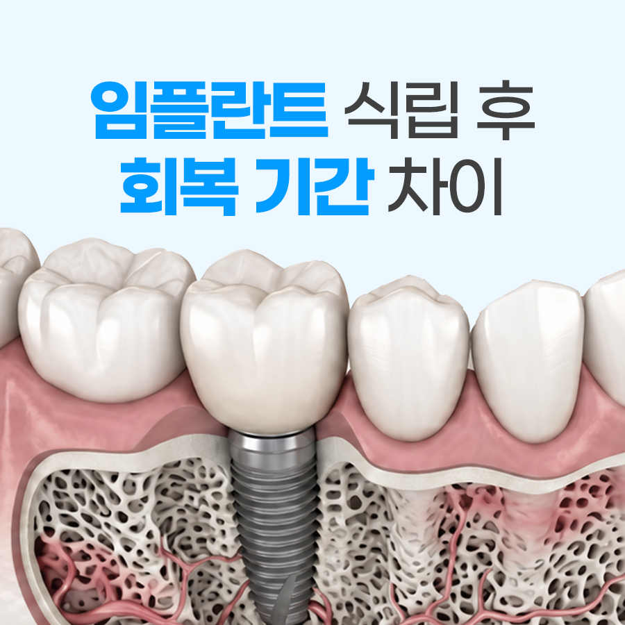 장유 율하 김해치과 임플란트 식립 후 골유착